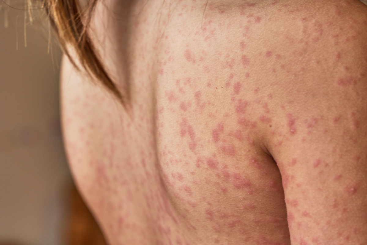 Understanding Biotinidase Deficiency and the Role of Meribin Supplements